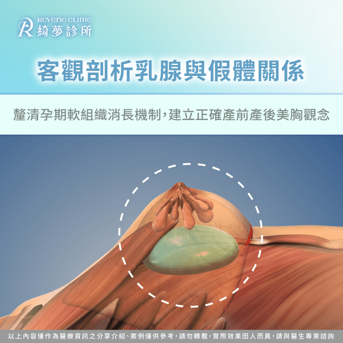 透過醫學解剖角度剖析乳腺與假體關係,客觀解答隆乳懷孕變形的疑慮。 隆乳後懷孕生理變化評估-隆乳懷孕變形