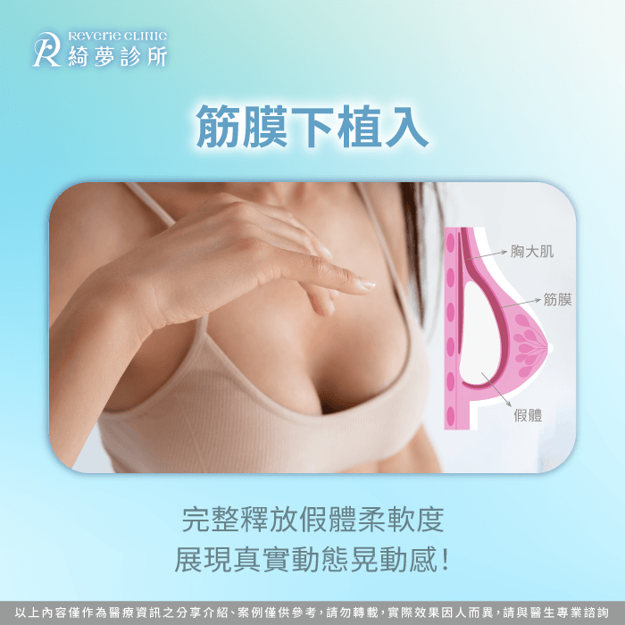 保留肌肉完整性能最大化釋放假體柔軟度並展現真實動態律動 筋膜下軟嫩觸感-隆乳 自然