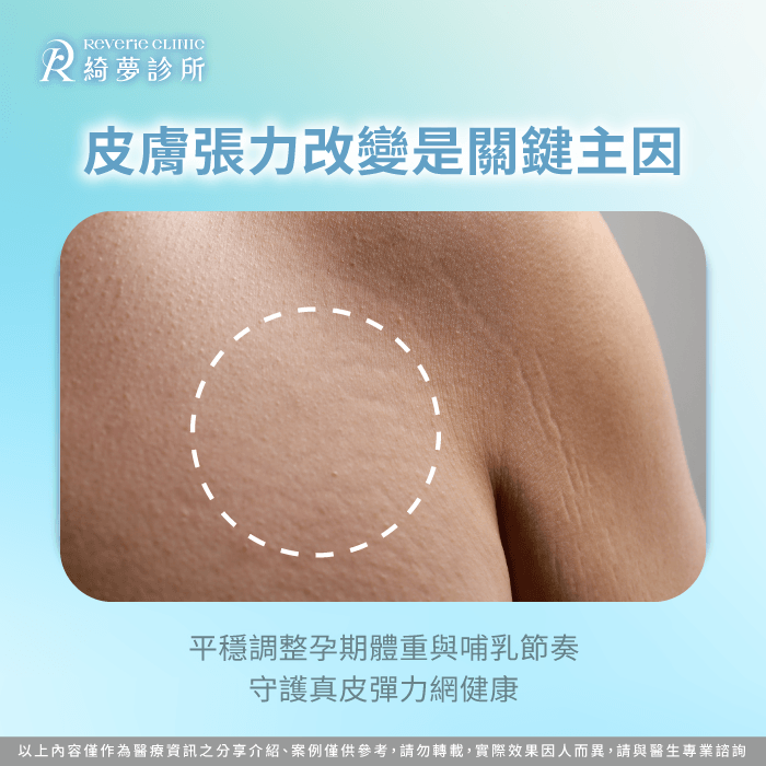 產後胸型變化主因為自體乳腺退化與皮膚彈性疲乏,非假體本身位置變動。 乳腺擴張與退奶萎縮機制-隆乳懷孕變形