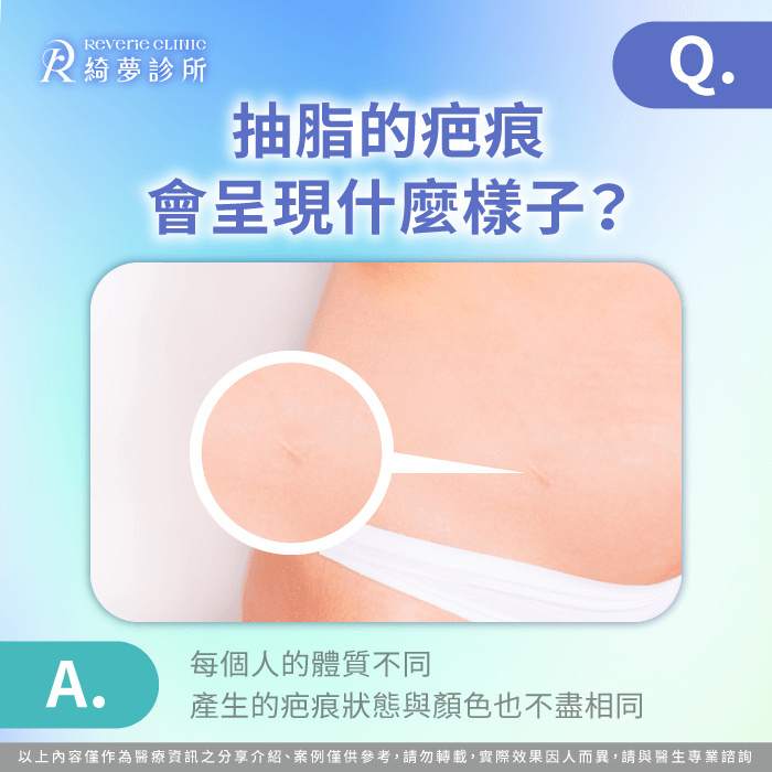 抽脂的疤痕會呈現什麼樣子-抽脂會留疤嗎