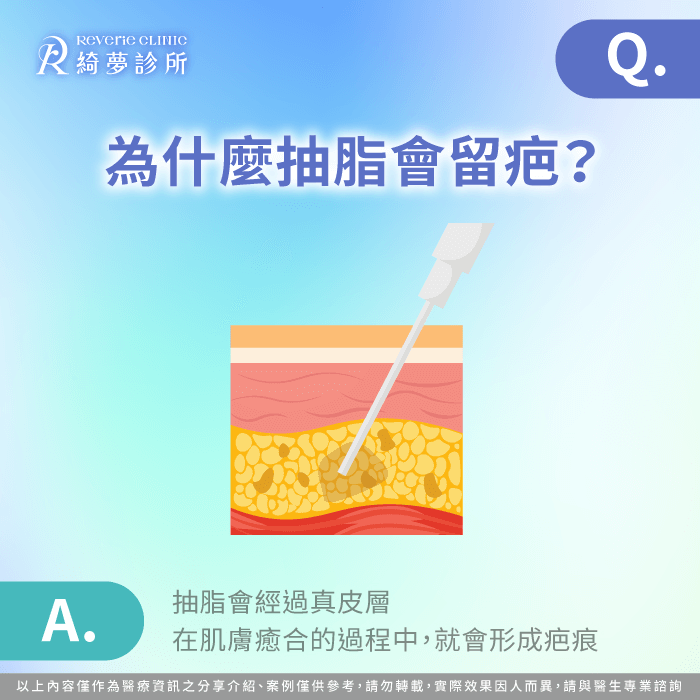 為什麼抽脂會留疤-抽脂會留疤嗎