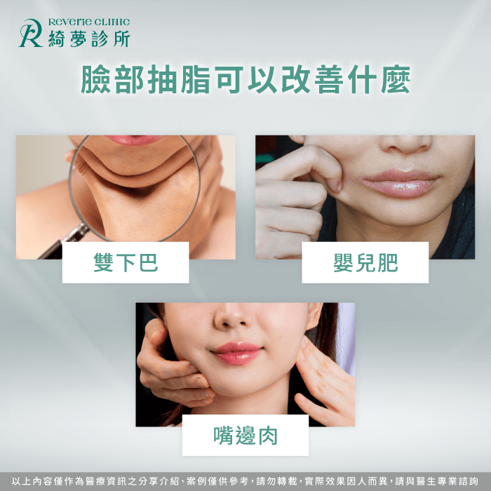 局部脂肪堆積如雙下巴與嬰兒肥,是臉部抽脂常見評估部位 抽脂可以改善的情形-臉可以抽脂嗎