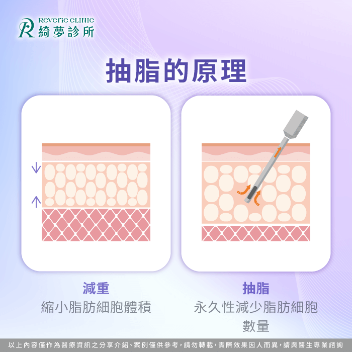 抽脂原理-抽脂可以瘦多少