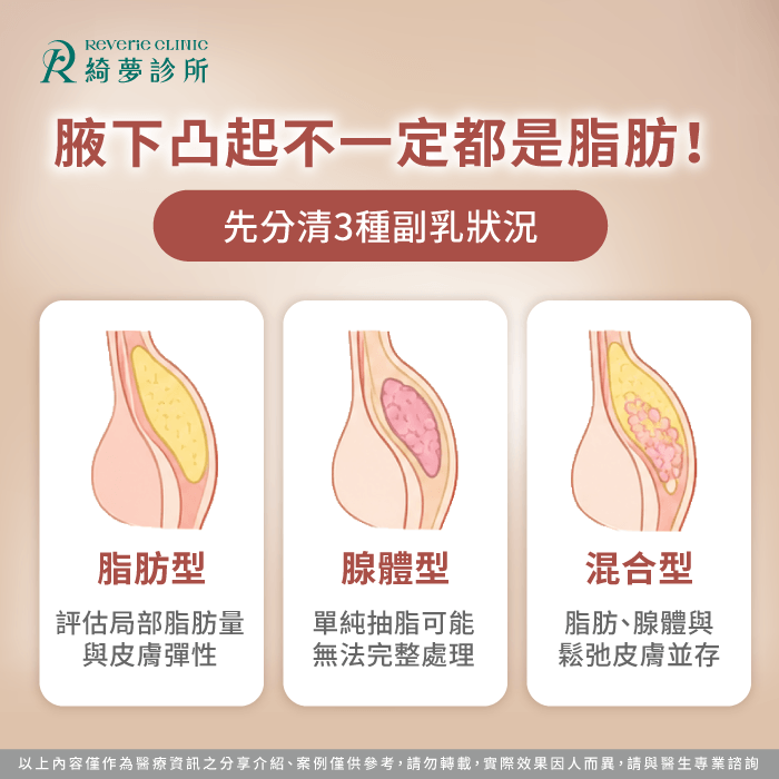 腋下凸起都是副乳嗎?先分辨脂肪、腺體與皮膚鬆弛 分辨腋下組織狀況-副乳可以抽脂嗎