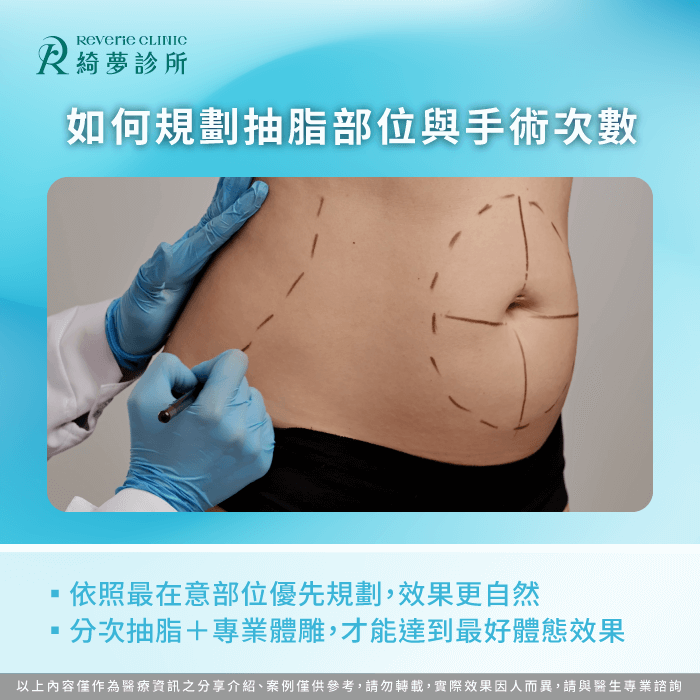 抽脂部位與分次計畫規劃,打造完美曲線 抽脂規劃-抽脂可以抽全身嗎
