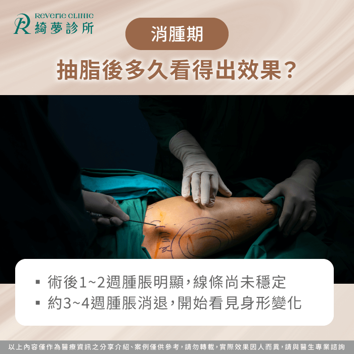 消腫期解析|抽脂後多久看得出效果與身形變化 消腫期-抽脂多久定型