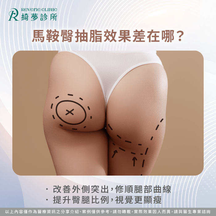 馬鞍臀抽脂效果差在哪-馬鞍臀 抽脂
