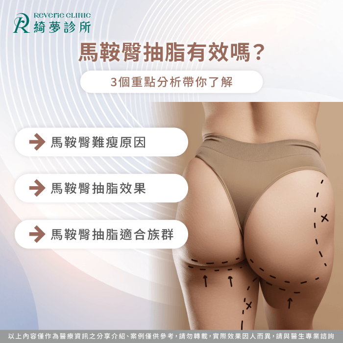 馬鞍肉 抽脂-馬鞍臀 抽脂