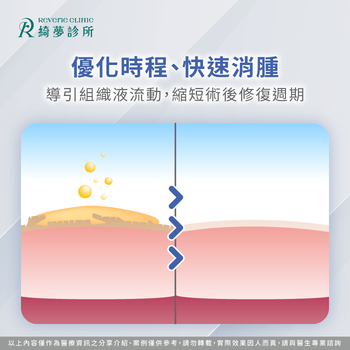 精確壓迫能有效引導組織液代謝並顯著優化抽脂消腫進度 優化術後修復消腫時程-抽脂後穿塑身衣