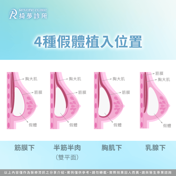 隆乳假體位置圖-隆乳水波紋是什麼
