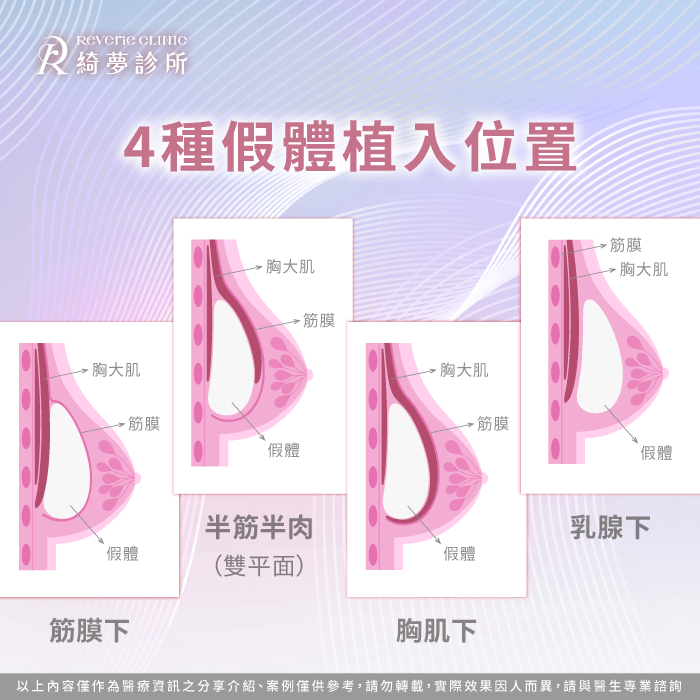 隆乳位置與優勢-女王波隆乳條件