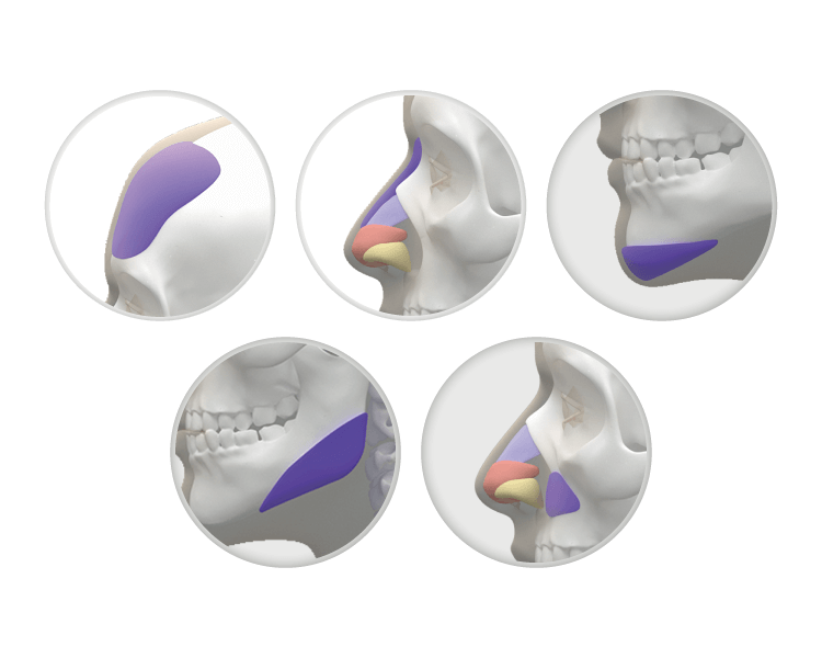 什麼是完形美FitMe 3D列印臉部假體