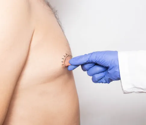 實際擠壓感受是否有疼痛感或過於敏感的情況 測試壓痛-台北男性女乳症手術推薦