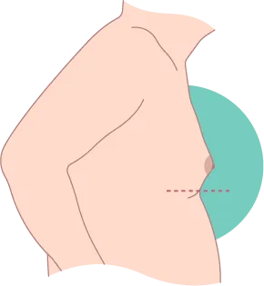 輕度女乳症一般無需治療,對外觀影響也不明顯 輕度女乳症-台北東區男性女乳症手術