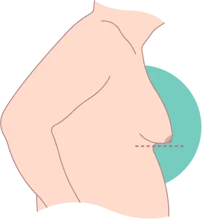 中重度男性女乳症已經有較多乳腺增生,外觀下垂明顯 中重度男性女乳症-台北東區男性女乳症手術