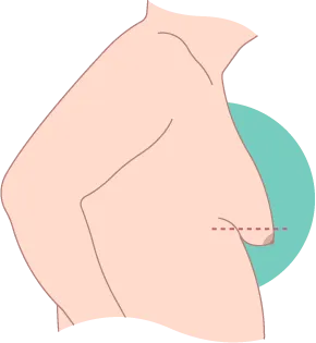 重度男性女乳症已有明顯女性乳房特徵,肌膚更鬆弛 重度男性女乳症-台北東區男性女乳症手術