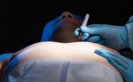 抽脂手術可以移除多於胸部脂肪改善外觀 抽脂手術-台北大安男性女乳症手術