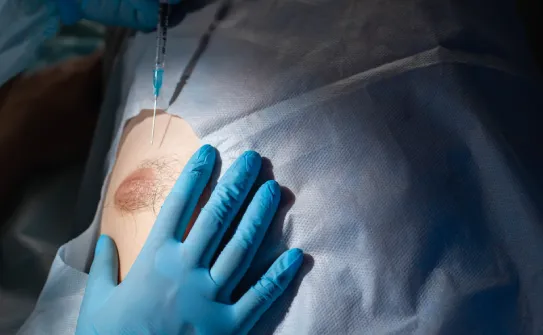 切除乳腺可以完整解決過度增生狀況 乳腺切除-台北大安男性女乳症手術