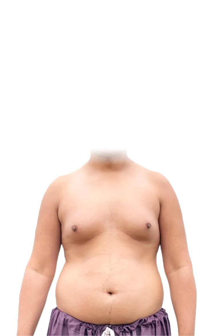 外觀更堅硬,乳頭因乳腺增生而更尖凸 腺體型男性女乳症-台北大安男性女乳症手術