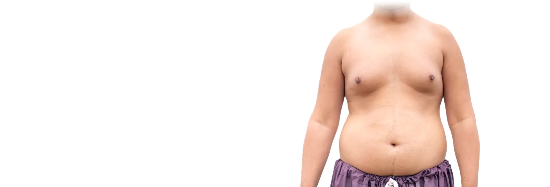 外觀更堅硬,乳頭因乳腺增生而更尖凸 腺體型男性女乳症-台北大安男性女乳症手術