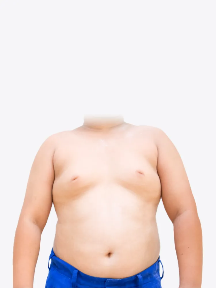 脂肪堆積通常起因於肥胖,胸部周圍的觸感較柔軟 脂肪型男性女乳症-台北大安男性女乳症手術