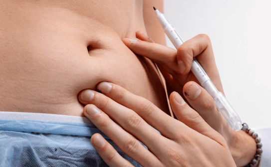 乳糜化技術讓抽脂線條更好掌握 LSSA音浪抽脂乳糜化脂肪,雕塑平滑身形線條