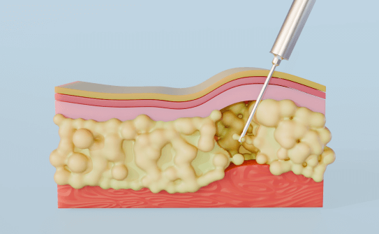 0.9mm至3.7mm探針滿足局部精雕需求 台北大安音浪抽脂,提供多尺寸探針精細客製