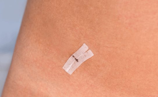 微創切口讓術後照護更簡單便利 台北微創音浪抽脂,小切口設計縮短術後修復期