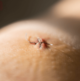 在意手術切口小與術後照護方便度的人 台北大安音浪抽脂服務,專為在意傷口大小與修復便利的患者設計